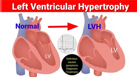 borderline lv hypertrophy|left ventricular hypertrophy mayo clinic.